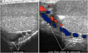 varicocele, Il varicocele: diagnosi e terapia