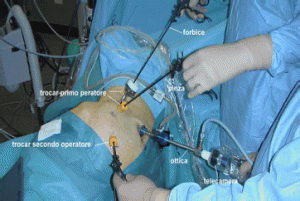 , Terapia Chirurgica: Come Asportare il Tumore e Salvare il Rene