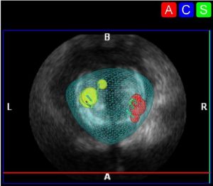 Biopsia in fusione di immagini