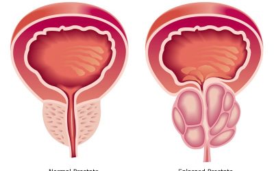Le dieci domande pi&uacute; frequenti sull&rsquo;Ipertrofia Prostatica