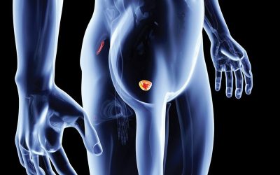 La diagnosi del tumore della prostata di ultima generazione: la biopsia in fusione di immagini