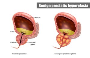 ingrossamento della prostata