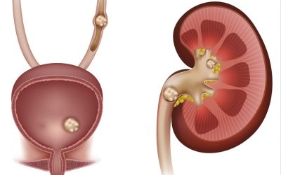 Calcolosi urinaria: sintomi, cause e prevenzione per i pazienti a basso rischio